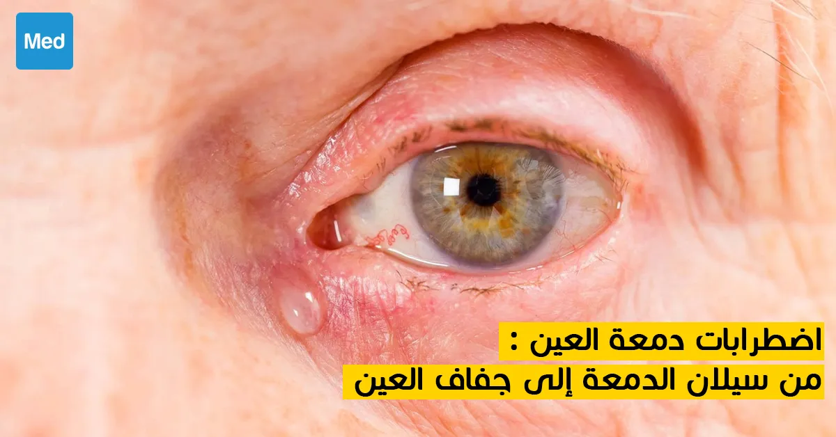اضطرابات دمعة العين : من سيلان الدمعة إلى جفاف العين